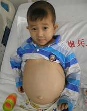 Yun suffers from portal hypertension