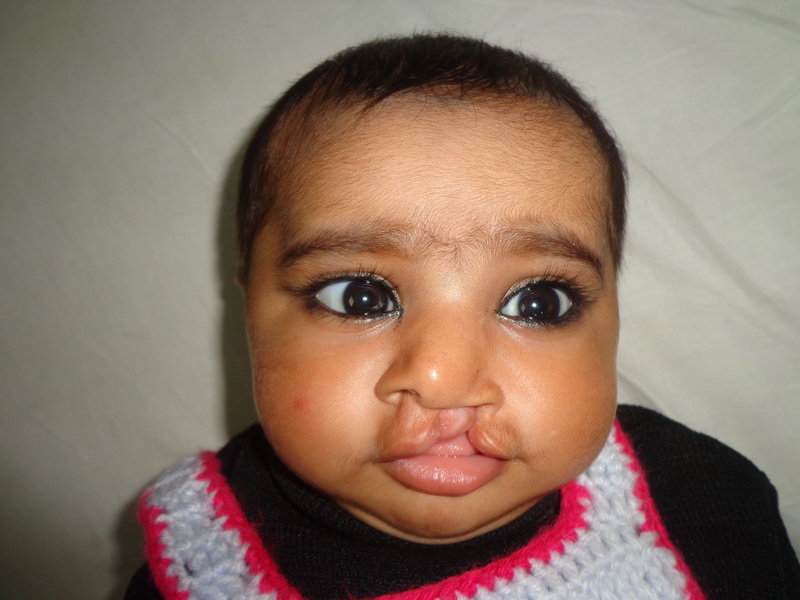 Save Cleft Lip & Palate Patients of Pakistan