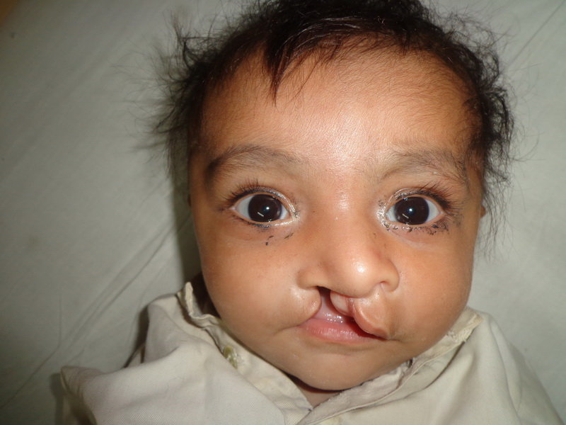 Save Cleft Lip & Palate Patients of Pakistan