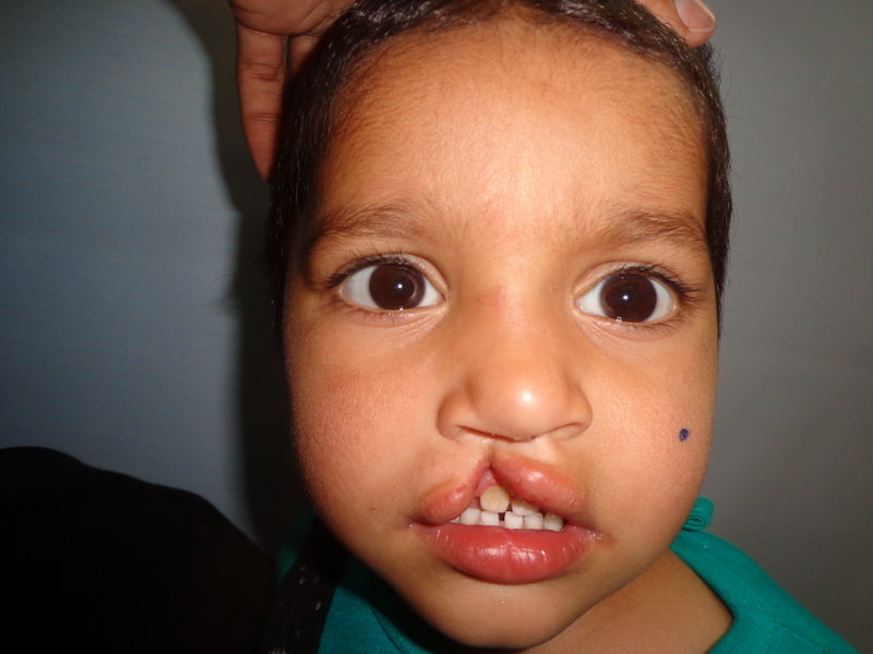 Save Cleft Lip & Palate Patients of Pakistan