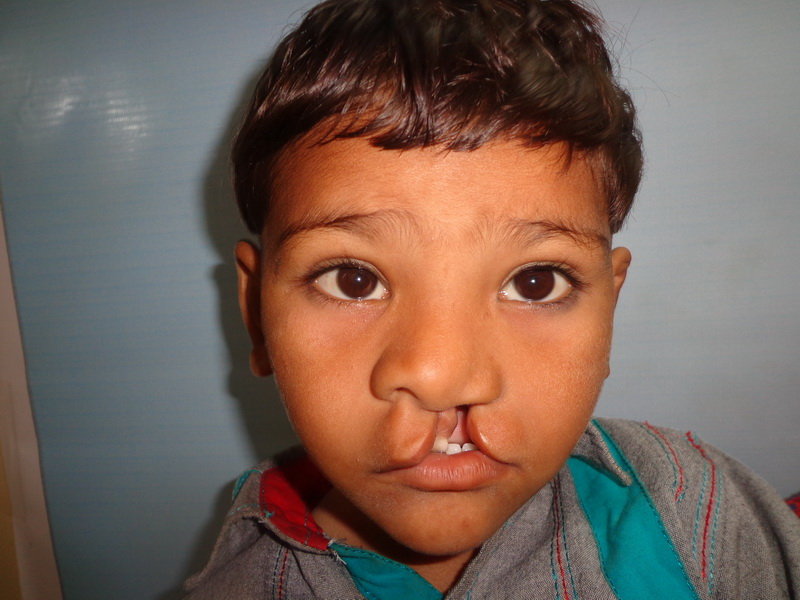 Save Cleft Lip & Palate Patients of Pakistan