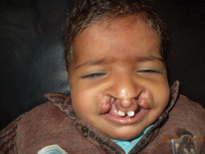 Save Cleft Lip & Palate Patients of Pakistan