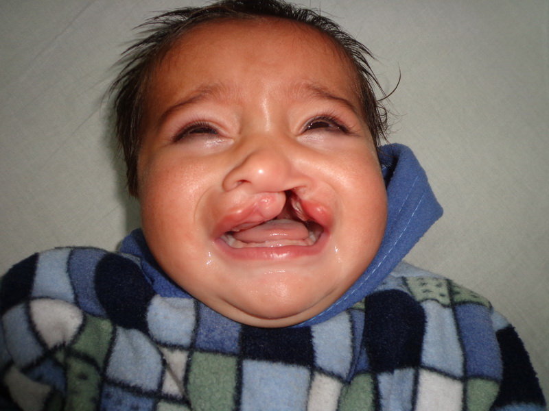 Save Cleft Lip & Palate Patients of Pakistan