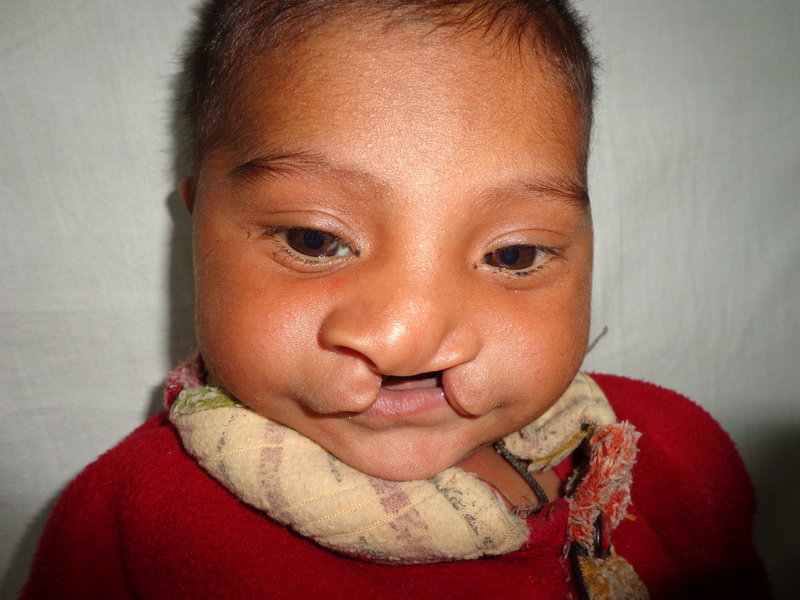 Save Cleft Lip & Palate Patients of Pakistan