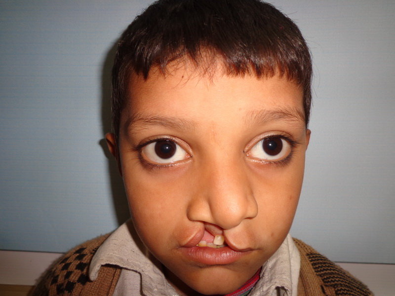 Save Cleft Lip & Palate Patients of Pakistan