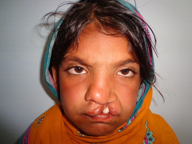 Save Cleft Lip & Palate Patients of Pakistan