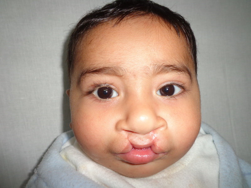 Save Cleft Lip & Palate Patients of Pakistan