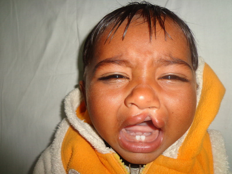 Save Cleft Lip & Palate Patients of Pakistan