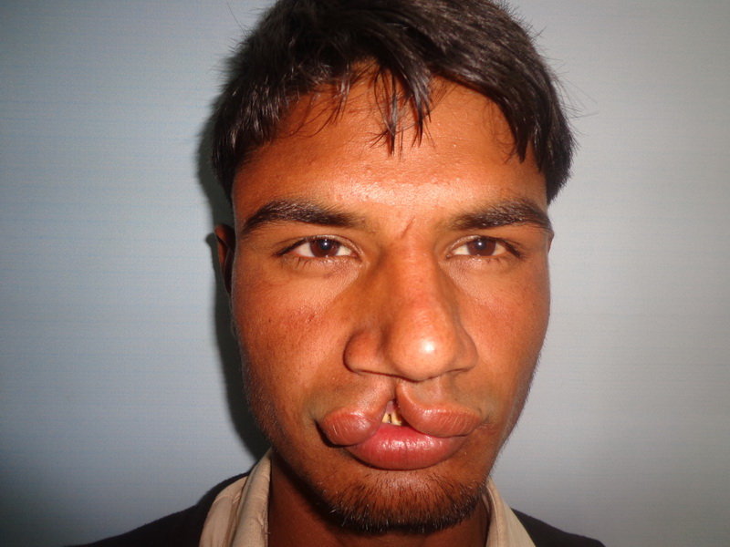 Save Cleft Lip & Palate Patients of Pakistan