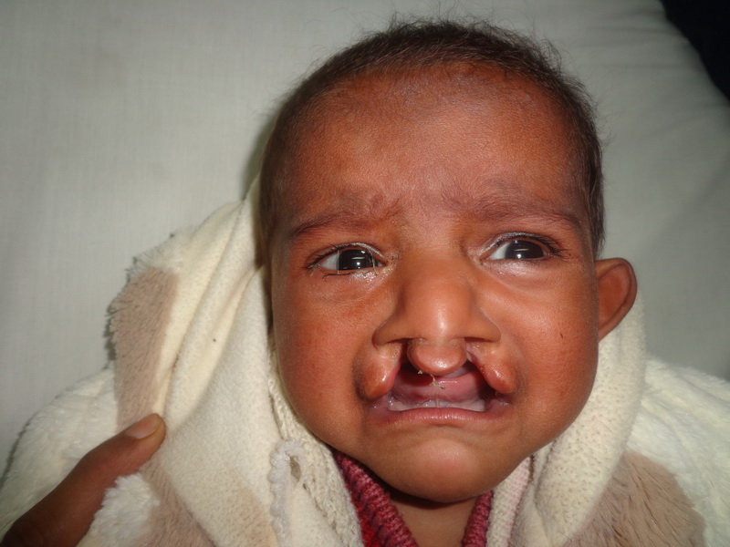 Save Cleft Lip & Palate Patients of Pakistan