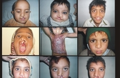 Save Cleft Lip & Palate Patients of Pakistan