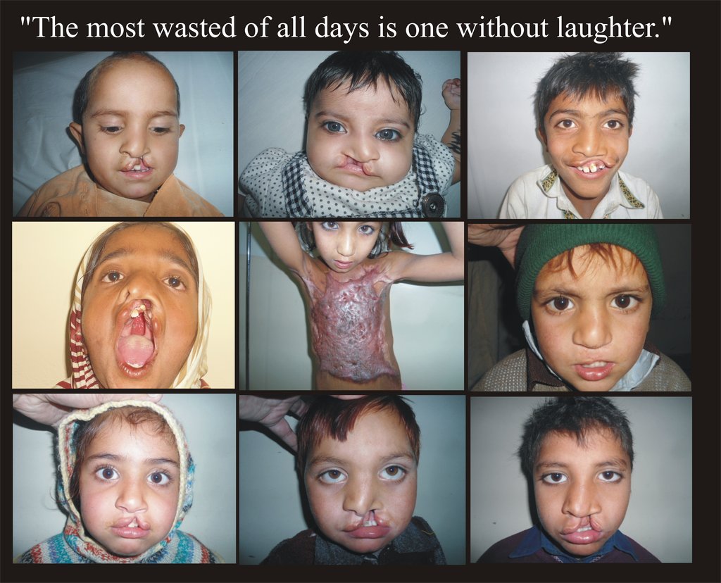 Save Cleft Lip & Palate Patients of Pakistan