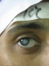 Yasmin with Cataract