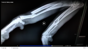x-ray of Caydens broken legs