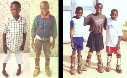 Treatment for 100 youth with disabilities in Congo