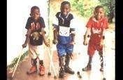 Treatment for 100 youth with disabilities in Congo
