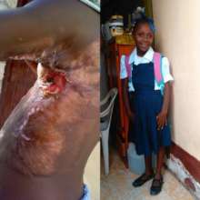 From abandoned burn victim to happy student!
