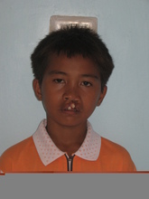 Photo of Jason before surgery was conducted