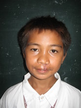 A new smile of jason after the surgery
