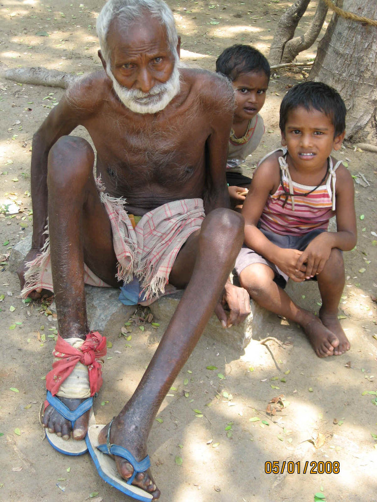 Construction of leprosy Hospital in India