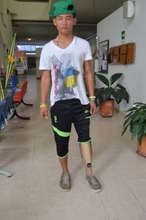 David and his new leg!