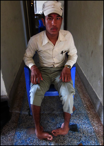 Homnath before reconstructive surgery.