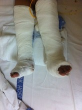 Shreya after surgery