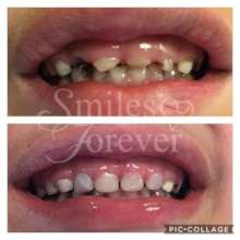 close-up of smile before and after