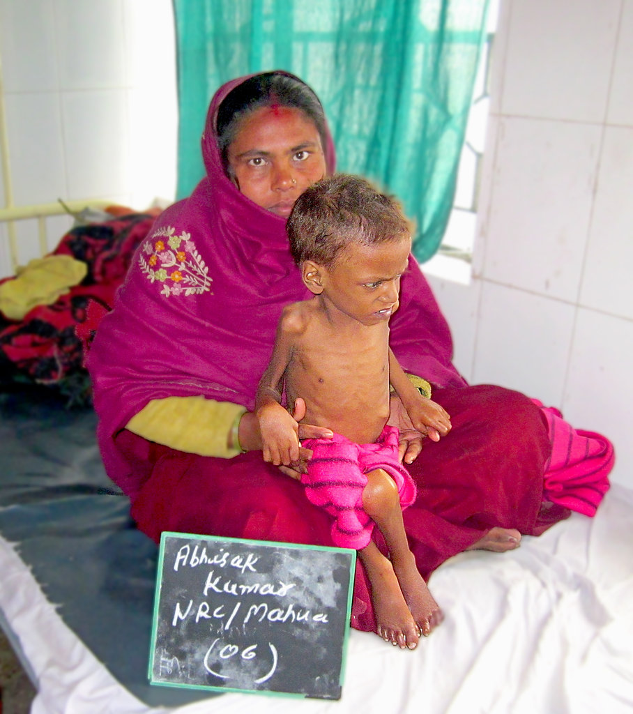To Save Severe Malnourished Children in Bihar.