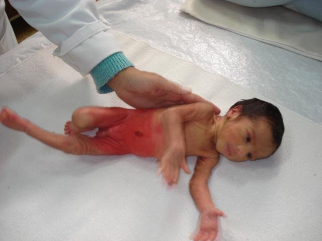 Fight Against Infant Mortality - 300 babies/year