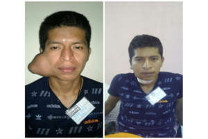 Juan, before and after his surgery
