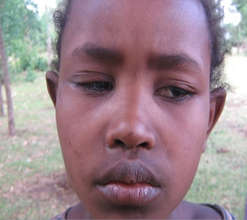 Abaynesh before surgery