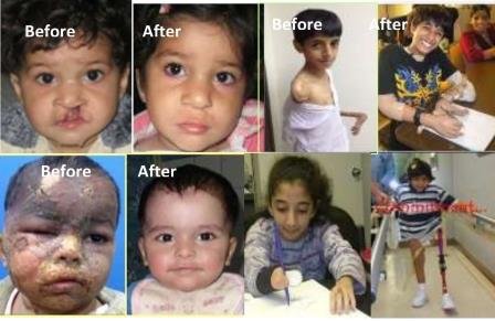 Medical Treatment for 100 Burn Children