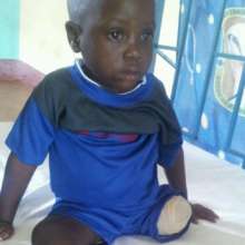 S.A. before getting the prosthesis