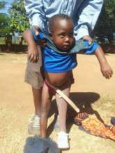 S.A. with prosthesis