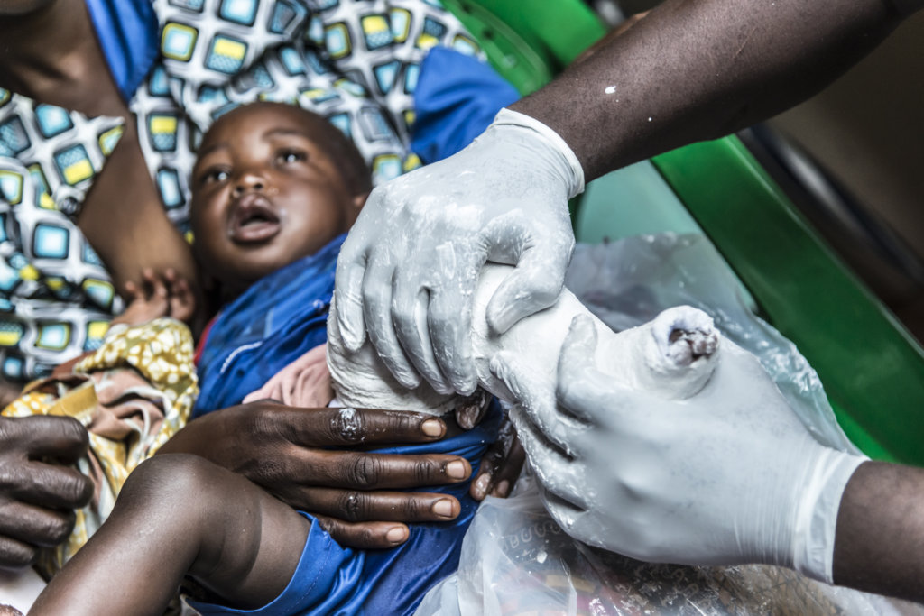 Protect 500 Kids with Disabilities in Malawi