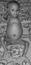 Severely malnourished baby