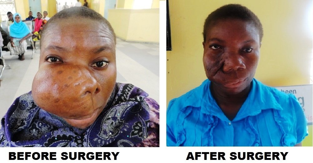 FREE  FACIAL DEFORMITY SURGICAL OUTREACH PROGRAMME