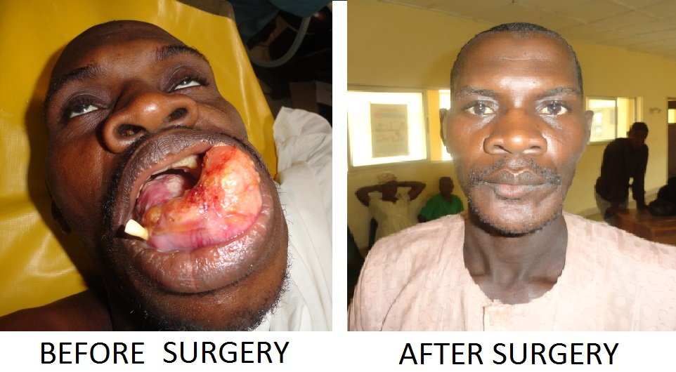 FREE  FACIAL DEFORMITY SURGICAL OUTREACH PROGRAMME