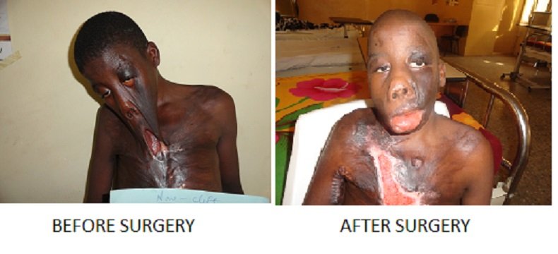 FREE  FACIAL DEFORMITY SURGICAL OUTREACH PROGRAMME