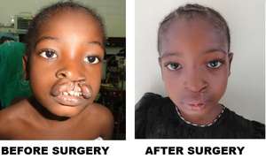 Patient with cleft lip