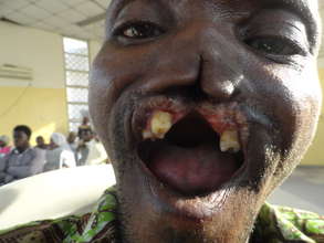 Patient with a case of Noma