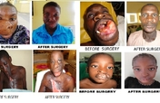 FREE  FACIAL DEFORMITY SURGICAL OUTREACH PROGRAMME