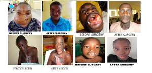 FREE  FACIAL DEFORMITY SURGICAL OUTREACH PROGRAMME