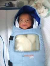 10 weeks male baby treated with laser