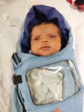 2 weeks female baby treated for ROP