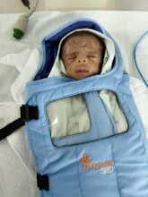 5 weeks male baby treated for ROP