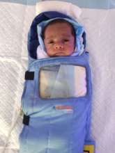 9 WEEKS BABY TREATED FOR ROP