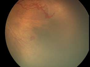APROP Fundus Photo