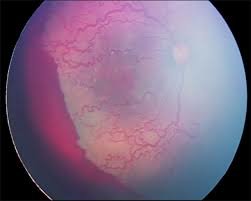 APROP fundus photo